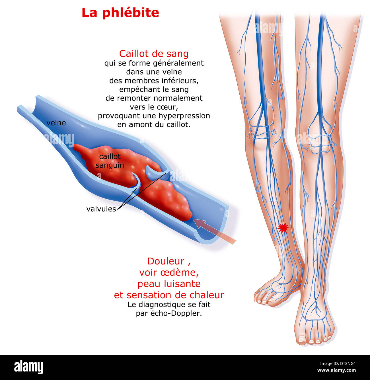 La trombosis venosa profunda fotografías e imágenes de alta resolución -  Alamy