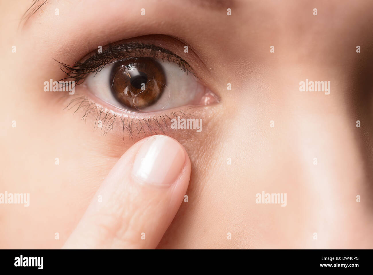 Lente de contacto en el ojo de una paciente femenina con las típicas burbujas de aire bajo la lente, extreme close up Foto de stock