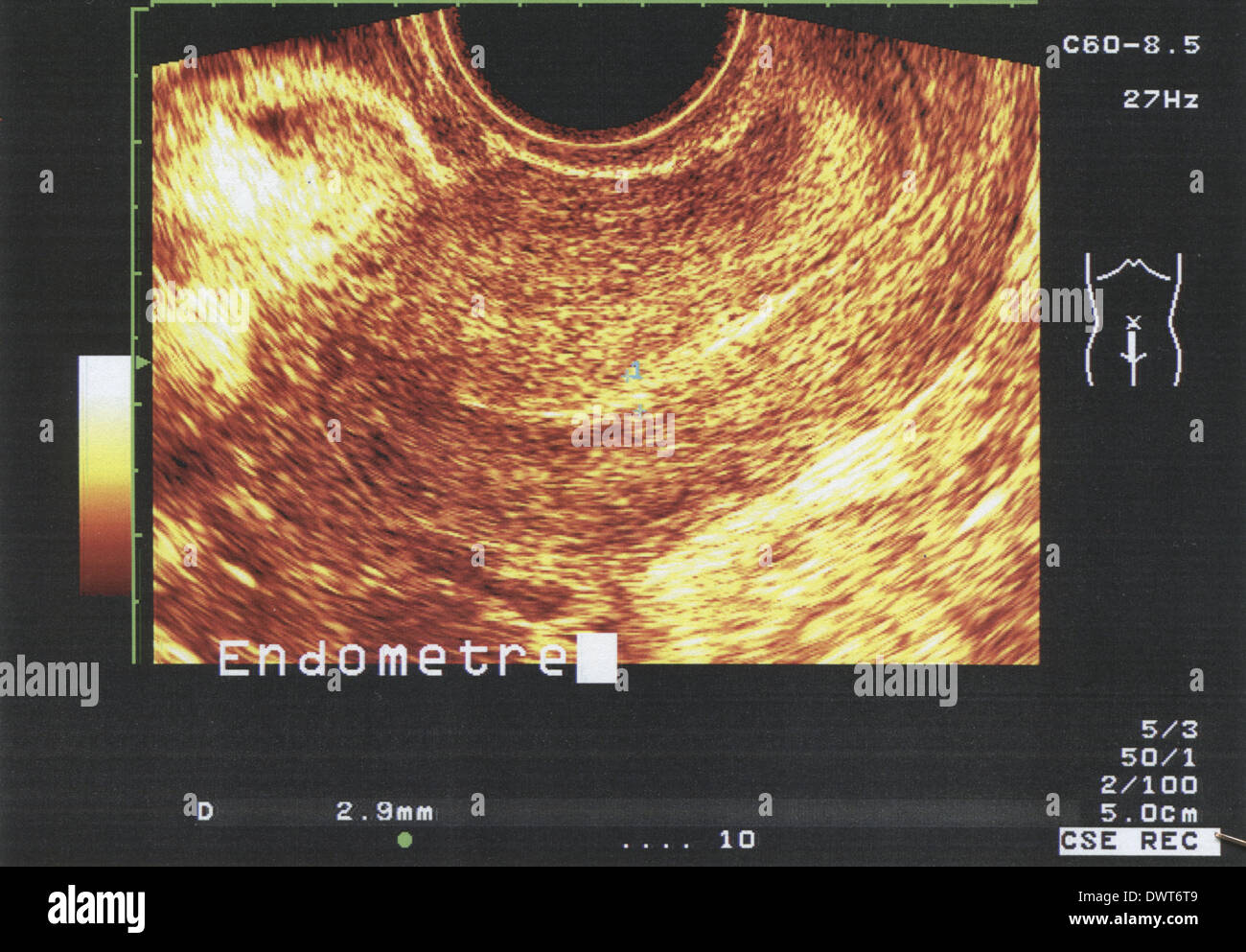 El ultrasonido pélvico Fotografía de stock Alamy