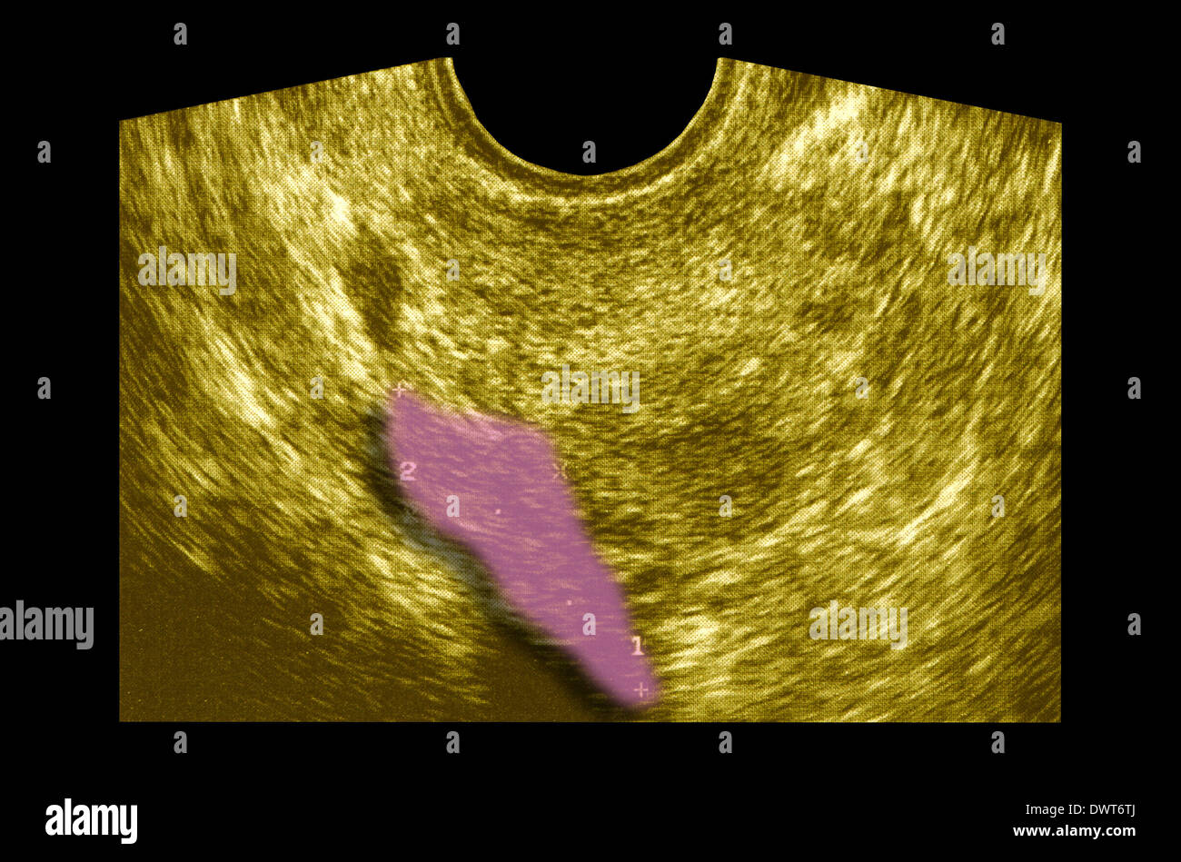El ultrasonido pélvico Fotografía de stock Alamy