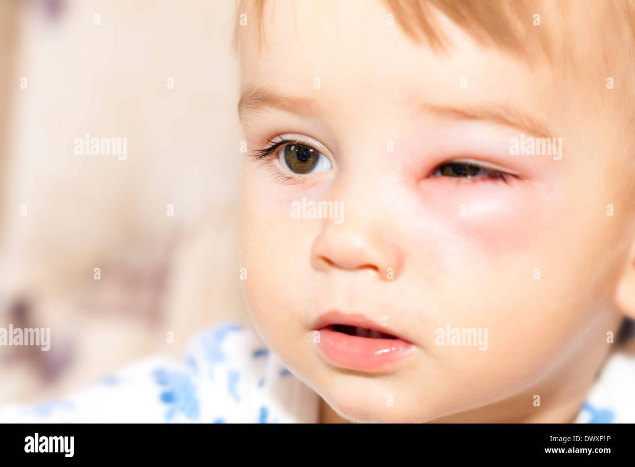 Little Boy - Peligrosas picaduras de avispas cerca del ojo Foto de stock