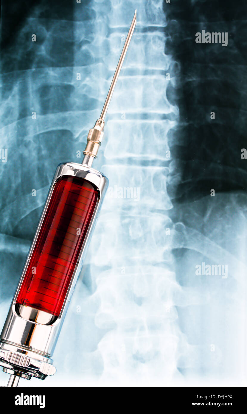 Injektionsnadel und Spritze vor einem Rˆntgenbild / aguja y jeringa delante de un X-ray, Spritze Roentgenaufnahme vor Foto de stock