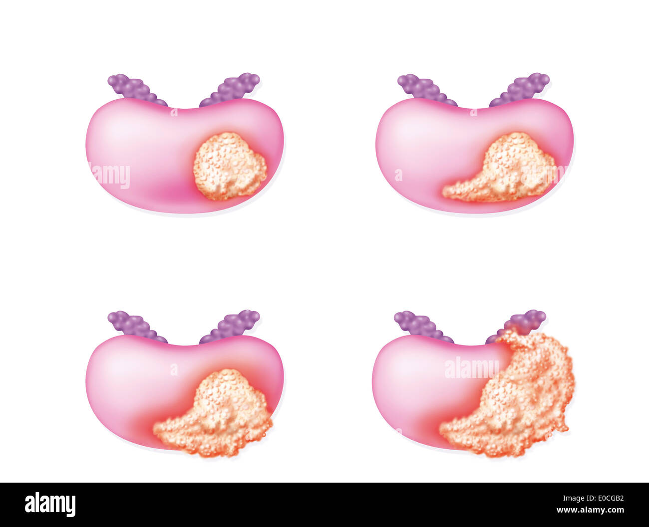 El cáncer de próstata, dibujo Foto de stock