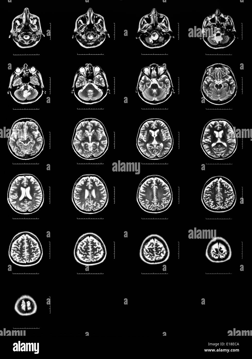 Secuencia de secciones horizontales de un cerebro humano - IRM Foto de stock