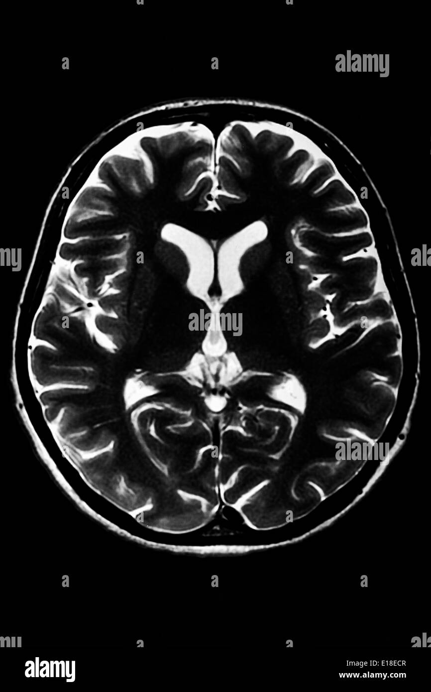Sección horizontal de un cerebro humano - IRM Foto de stock