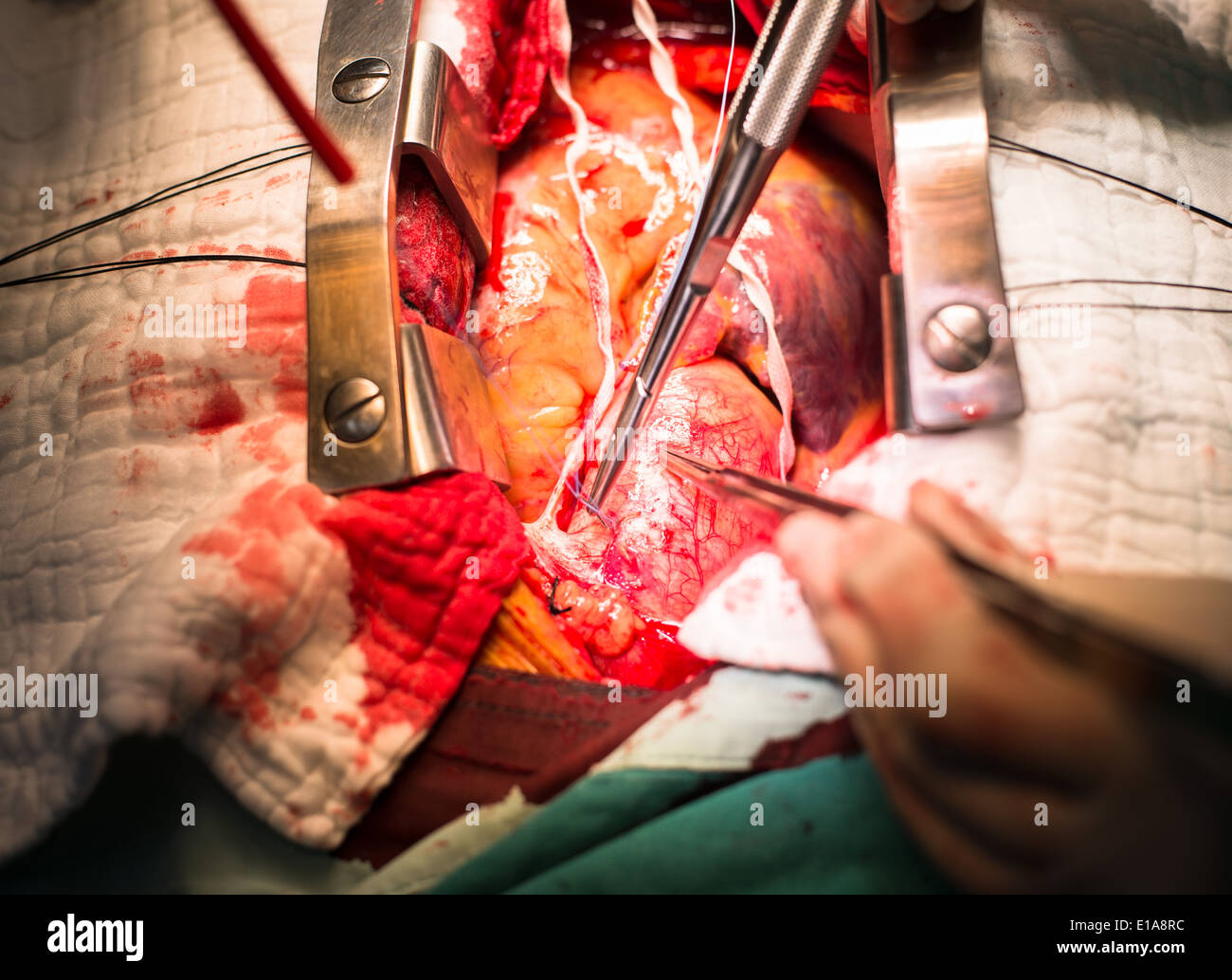 Realizar sutura aorta ascendente Foto de stock
