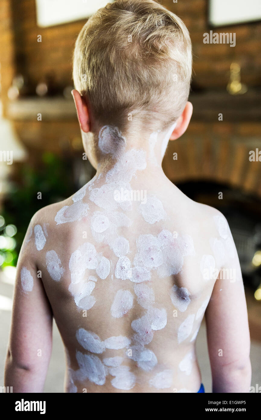 Un niño de cinco años que están siendo tratados por varicela. Foto de stock
