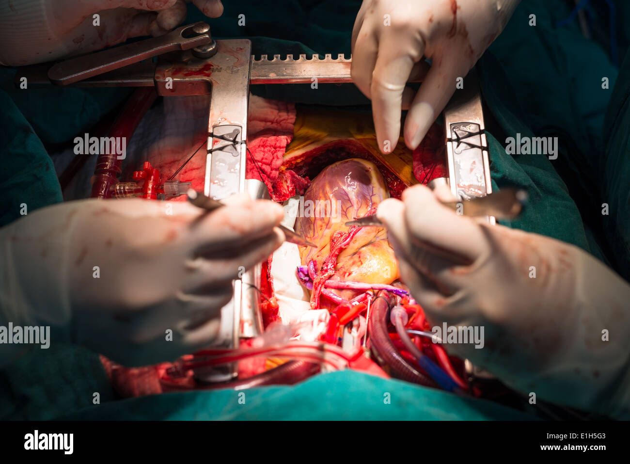 Injerto de derivación de la arteria coronaria Foto de stock