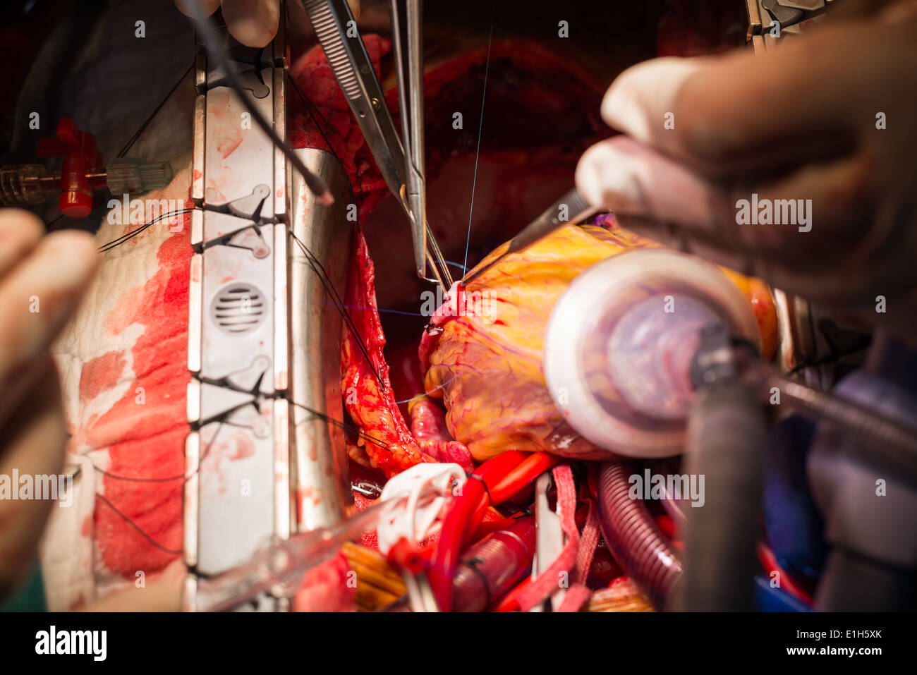 Injerto de derivación de la arteria coronaria Foto de stock