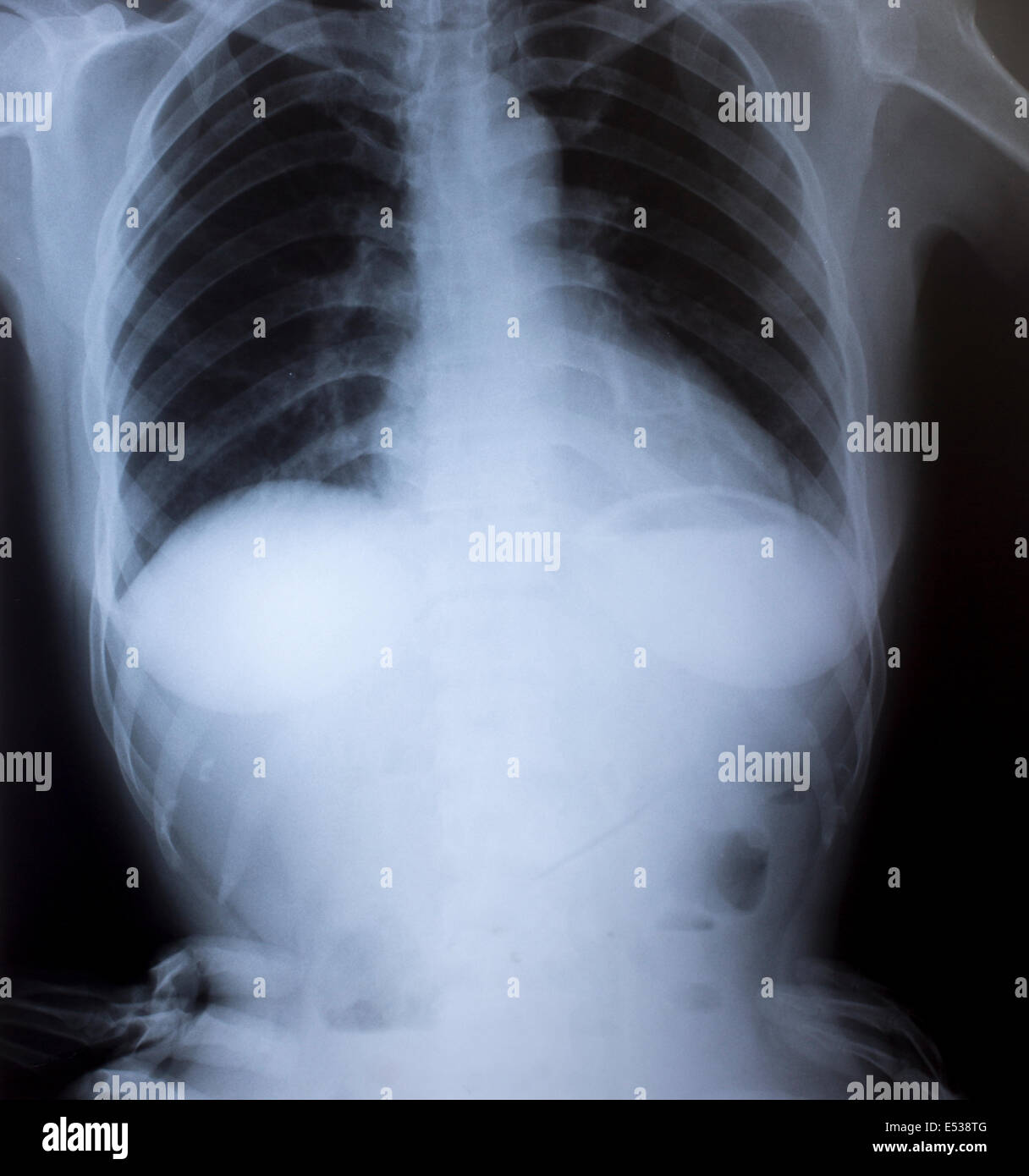 Imagen de rayos X de tórax humano para un diagnóstico médico Fotografía