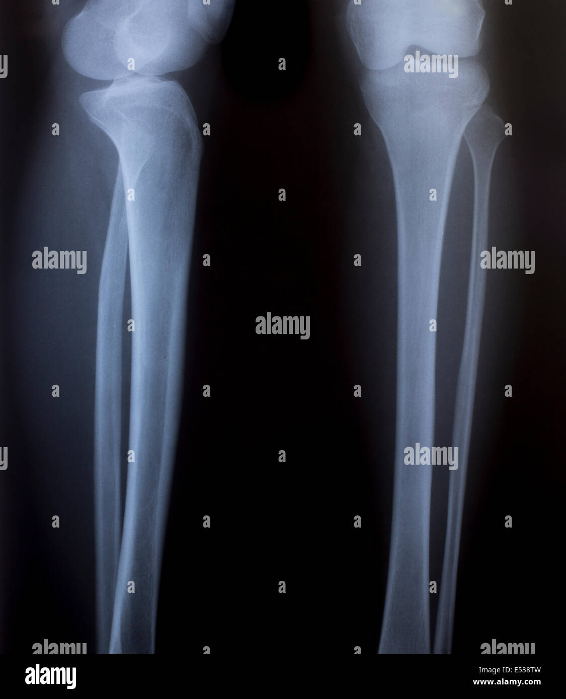 Imagen de rayos X de tórax humano para un diagnóstico médico Fotografía