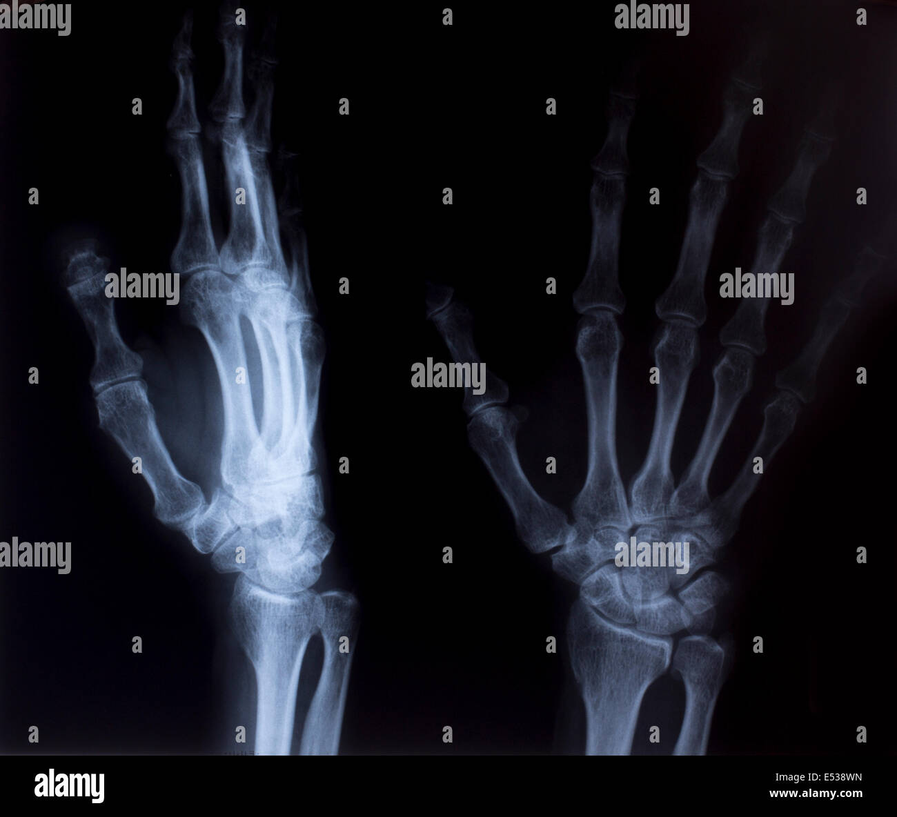 Imagen de rayos X de tórax humano para un diagnóstico médico Fotografía