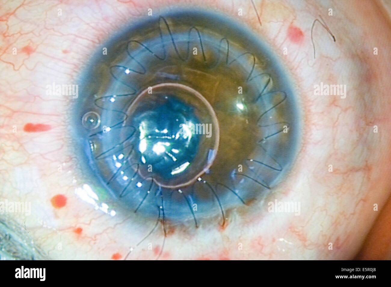 Injerto corneal, las suturas son visibles en los trasplantados de córnea. Foto de stock
