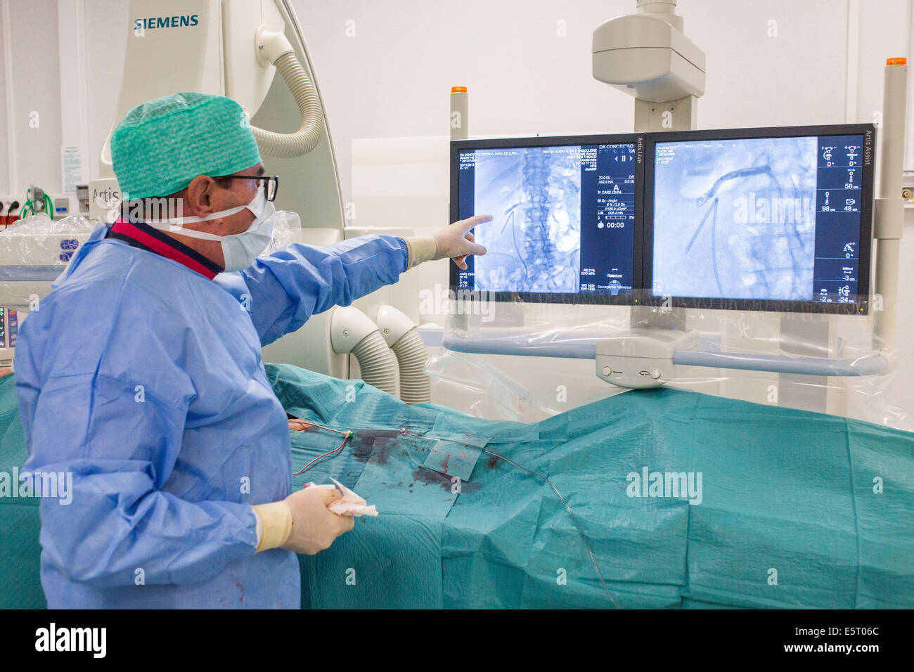 Tratamiento de la estenosis de la arteria renal por embolización, hospital de Angulema, Francia . Foto de stock