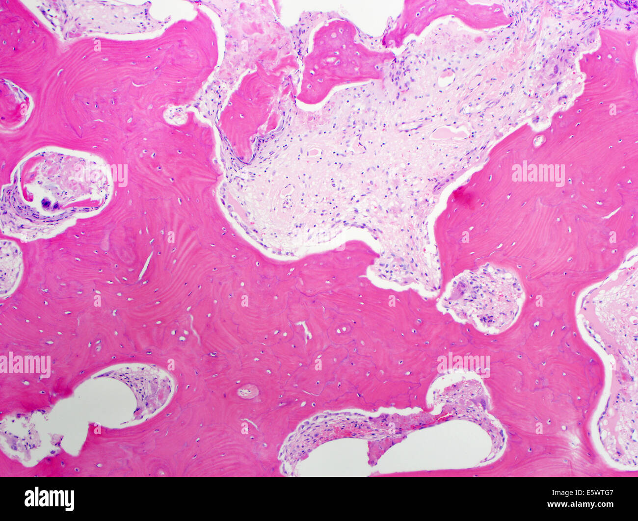 Tinción de H&E, la microscopía de luz, la enfermedad de Paget de hueso Foto de stock