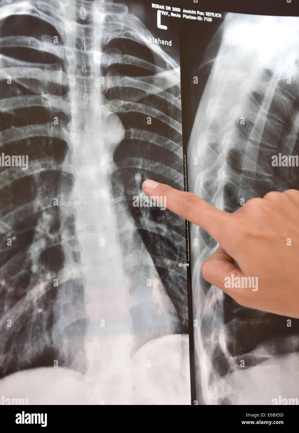 Mostrando,x ray,fractura costal Foto de stock