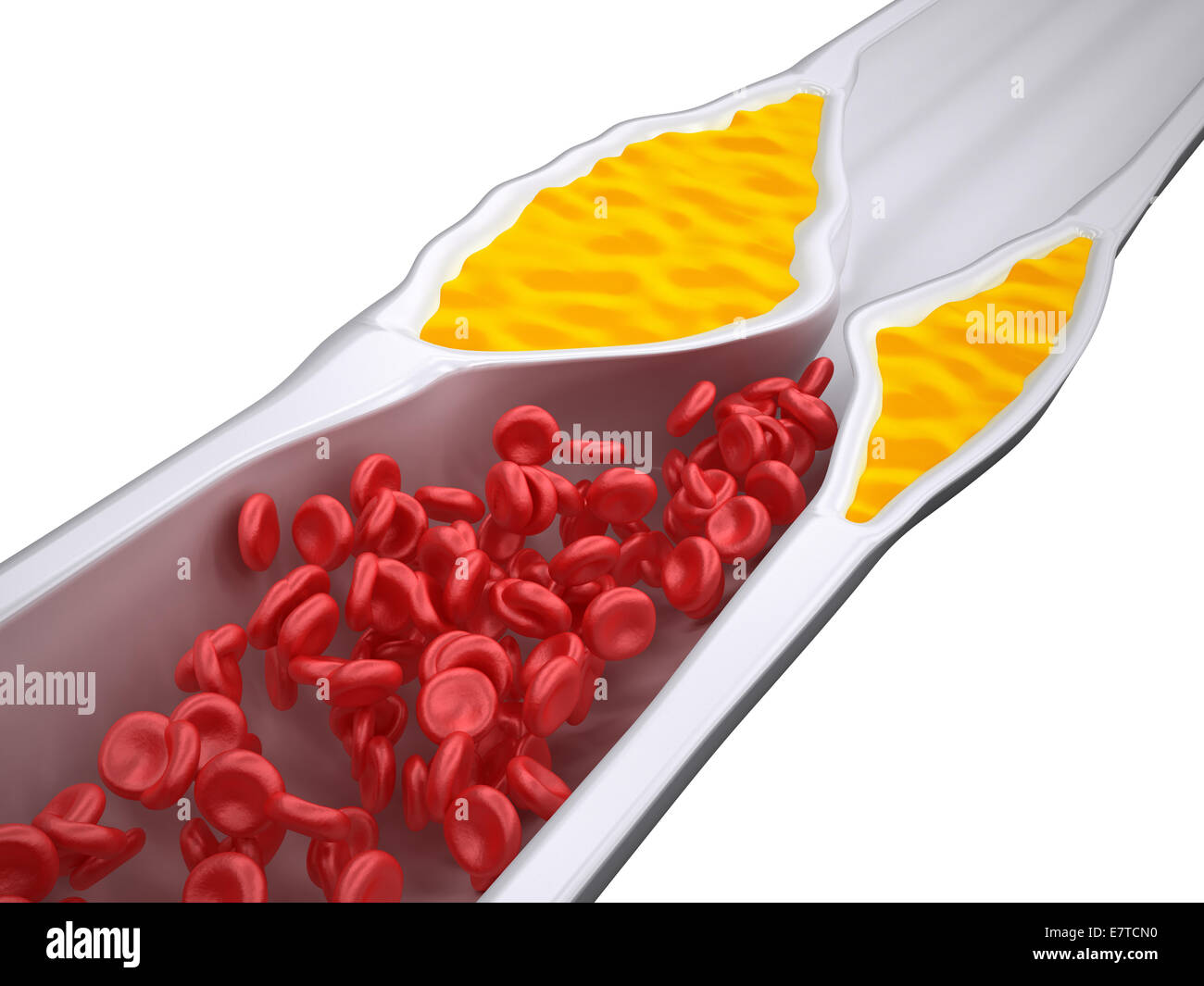 Arteria tapada - Aterosclerosis / Arteriosclerosis - placa de colesterol - iso ver Foto de stock