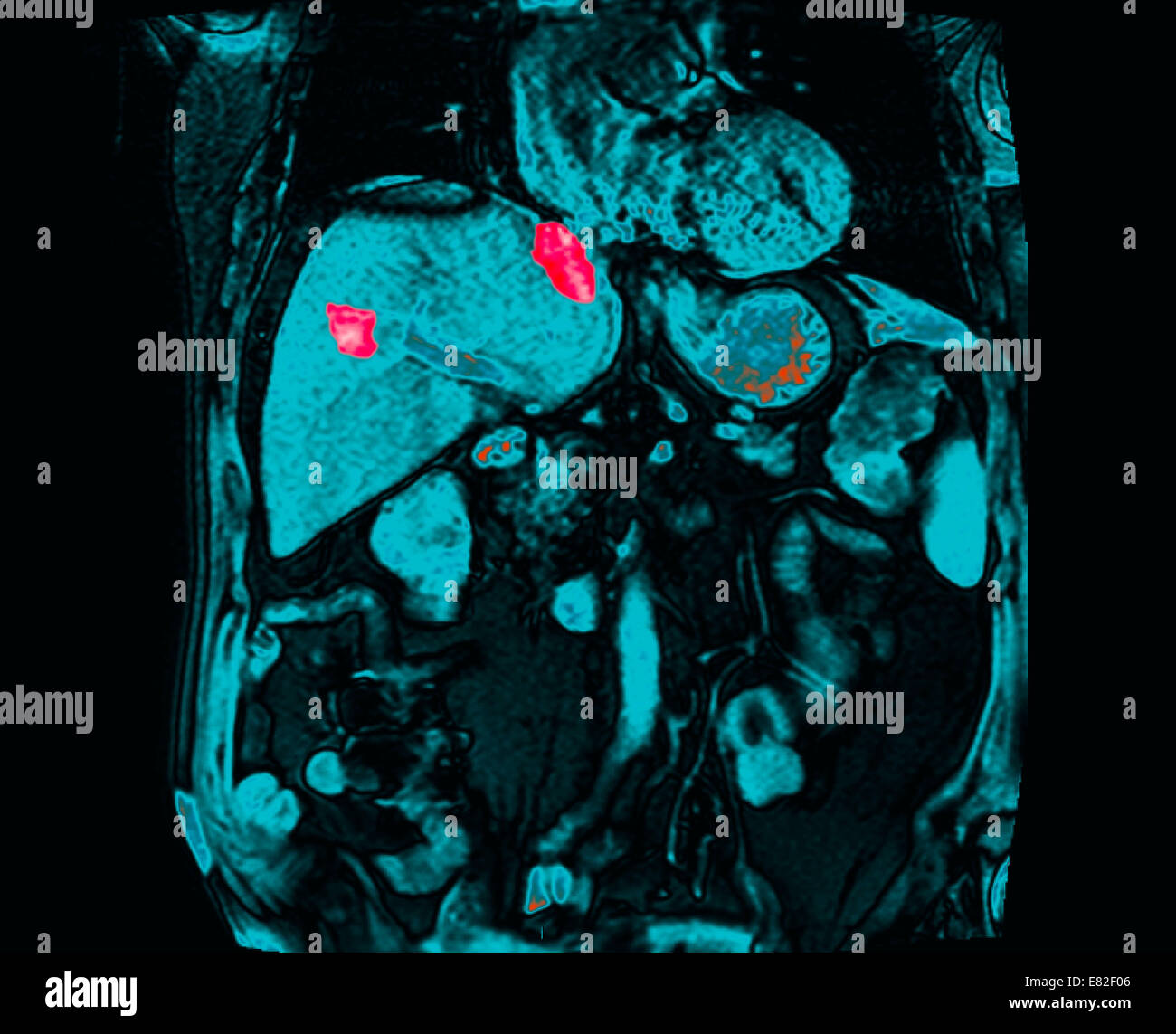 Tomografía computarizada de un paciente con cáncer de recto y metástasis hepáticas. Foto de stock