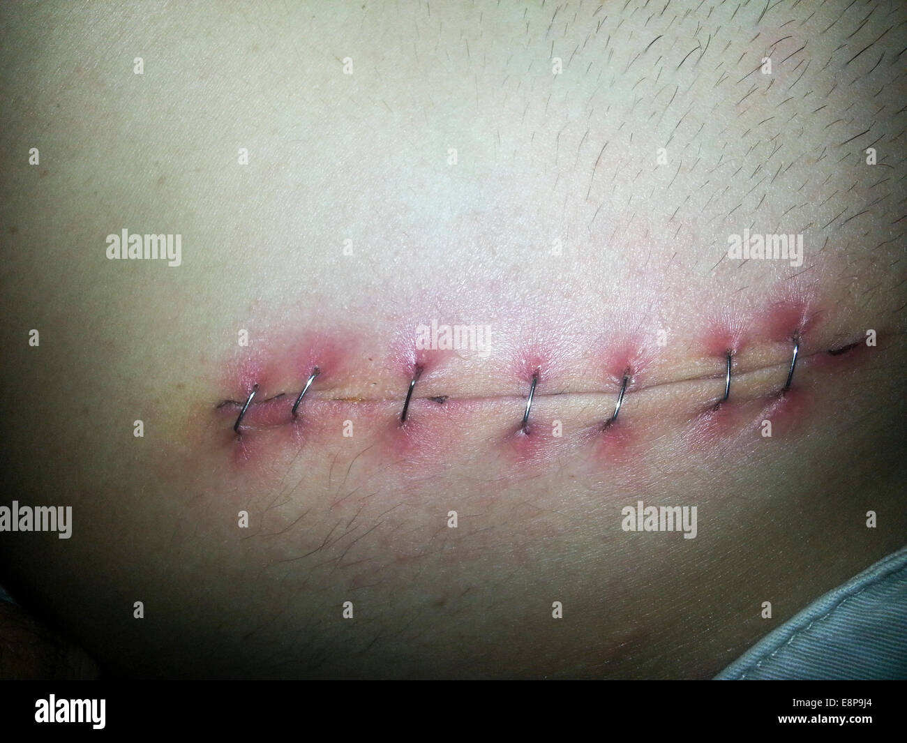 Las suturas de metal (grapas de metal). Vista de las grapas metálicas, cerrando una herida quirúrgica en el abdomen de un hombre. Foto de stock