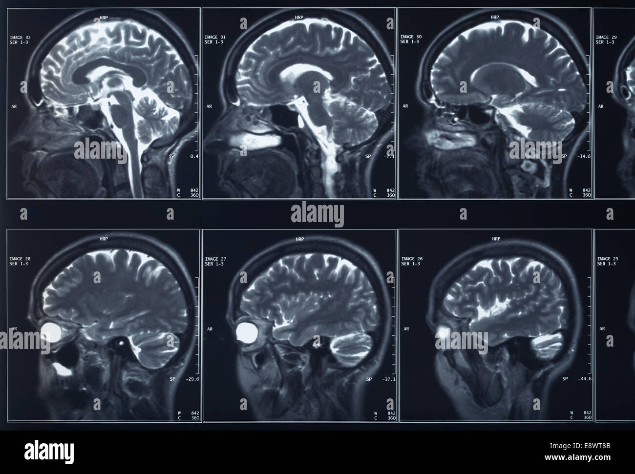 Radiografía de la cabeza y el cerebro Foto de stock