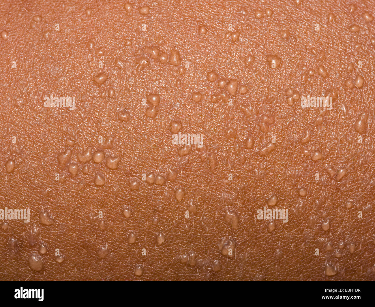Ampollas en la piel fotografías e imágenes de alta resolución - Alamy