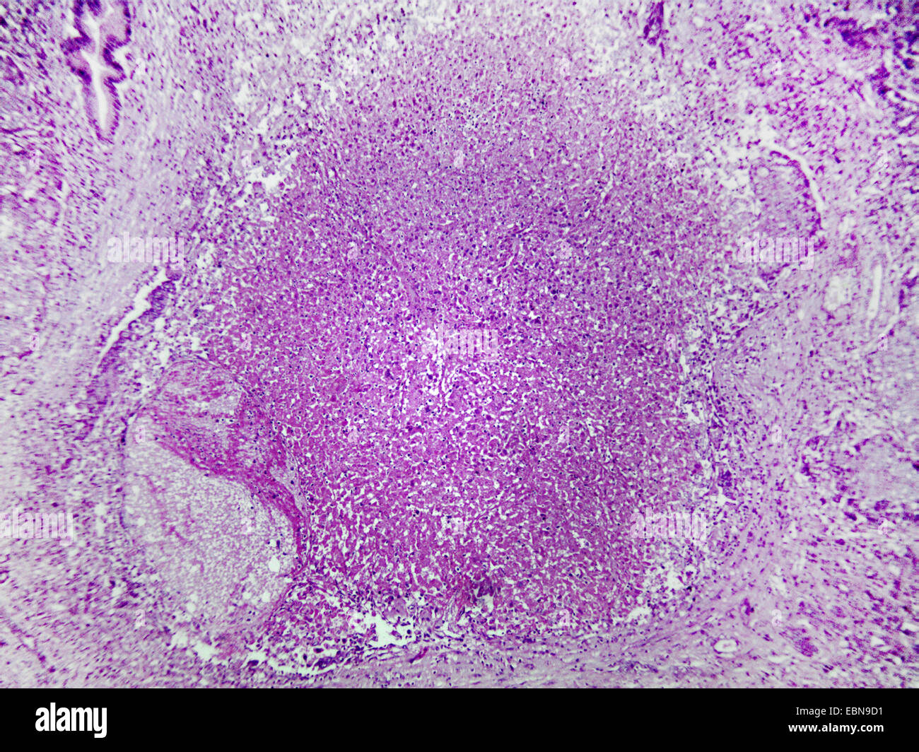 El cáncer hepático, sección microscópico, 100 x Foto de stock