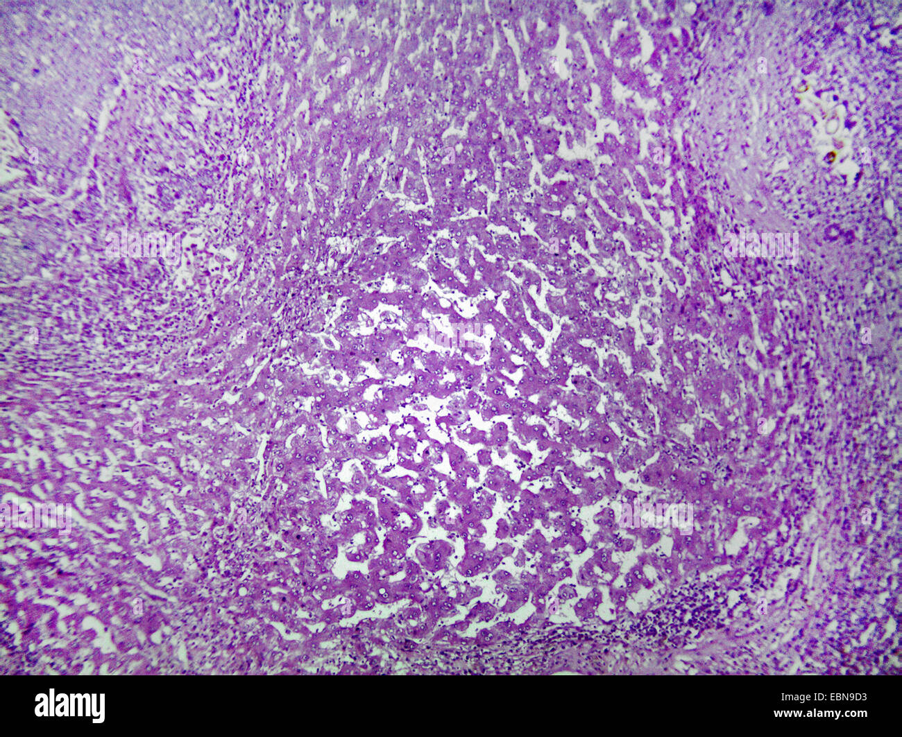 El cáncer hepático, sección microscópico, 100 x Foto de stock
