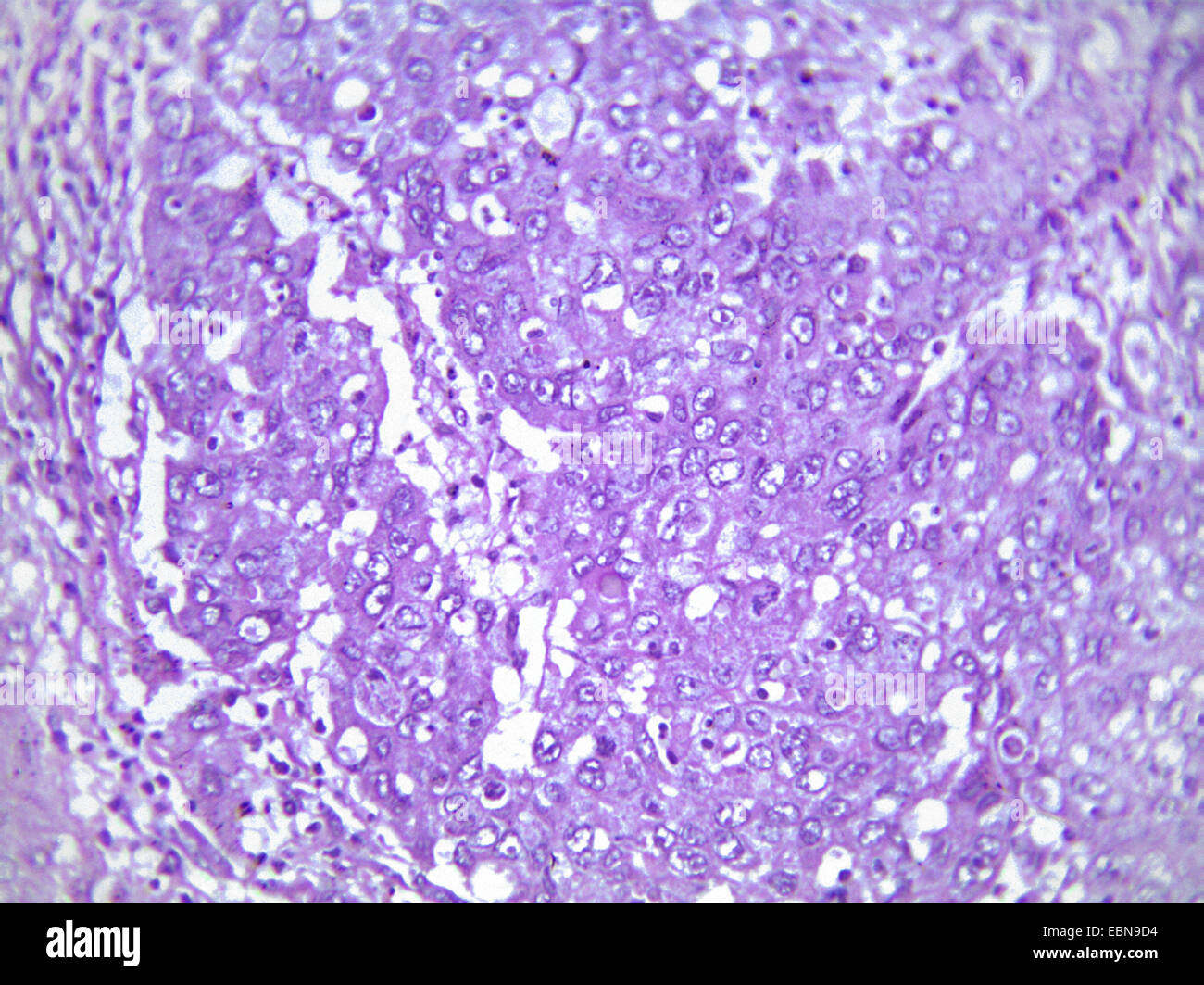 El cáncer hepático primario, sección microscópico, 400 x Foto de stock