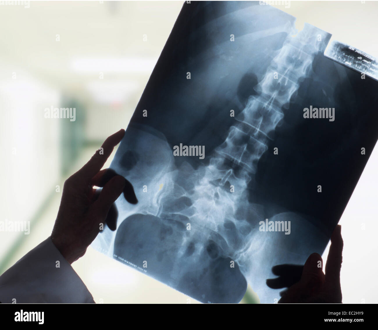 Manos sosteniendo macho humano de rayos X de la columna vertebral en el hospital hall Foto de stock