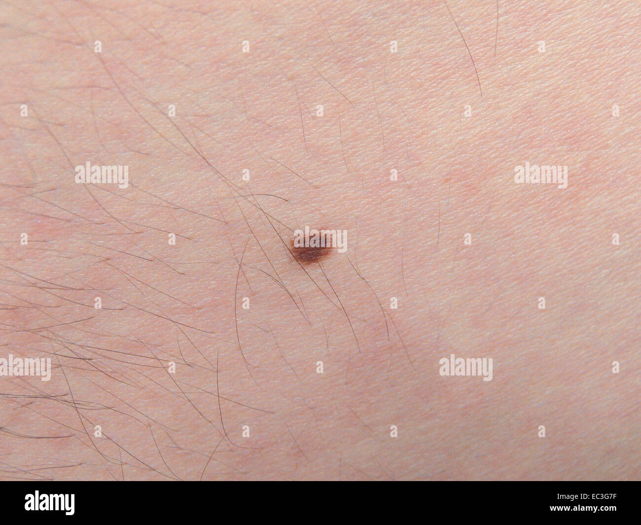 Mole, Belleza, melanoma, marca de nacimiento, nevus Foto de stock