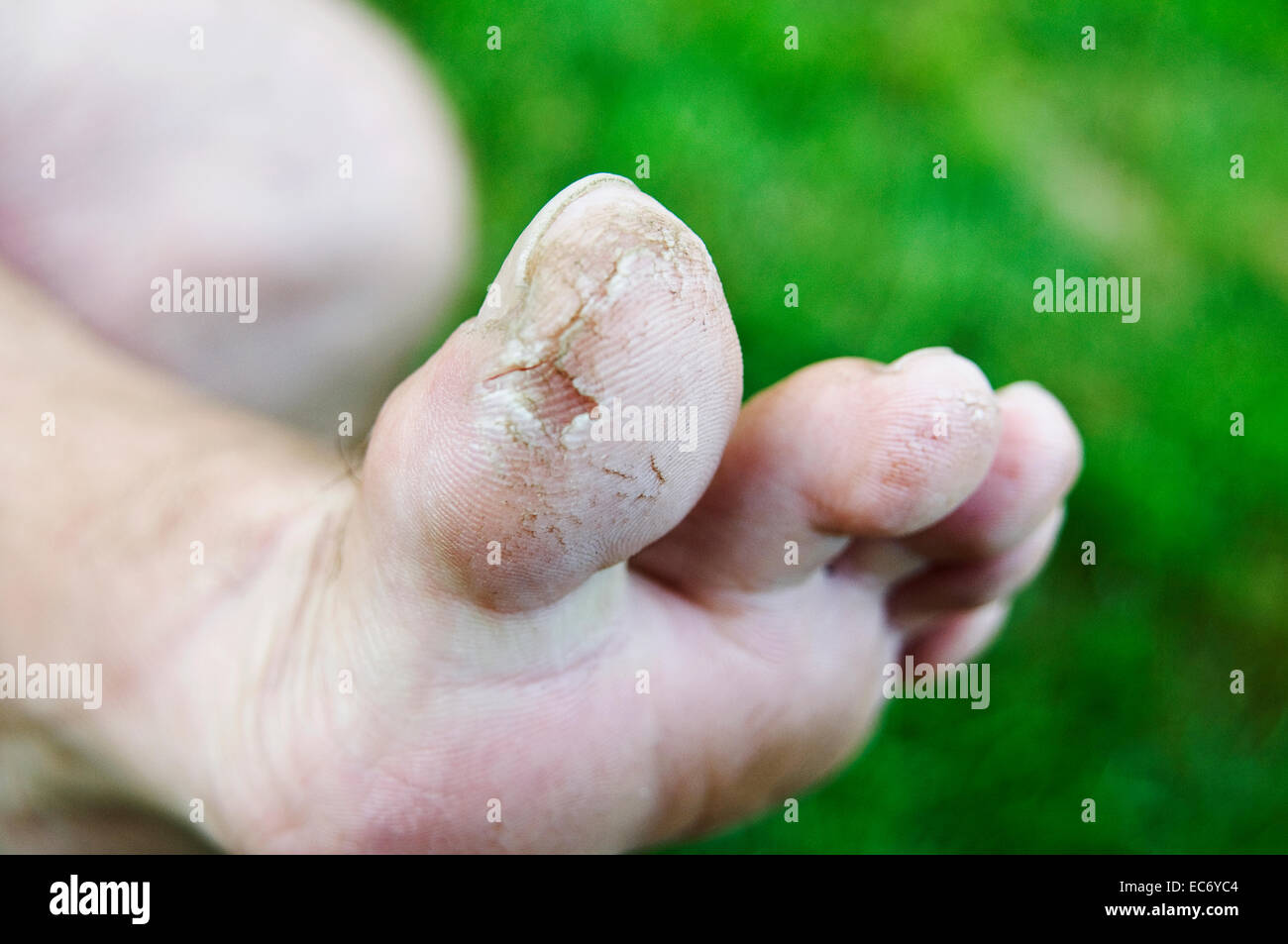 Hongo de pie de atleta fotografías e imágenes de alta resolución Alamy