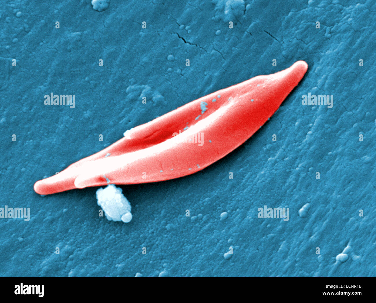 Colorea digitalmente análisis micrografía de electrones (SEM) de células falciformes de glóbulos rojos (RBC) encontró en una muestra de sangre de una paciente femenina de 18 años con anemia de células falciformes Foto de stock