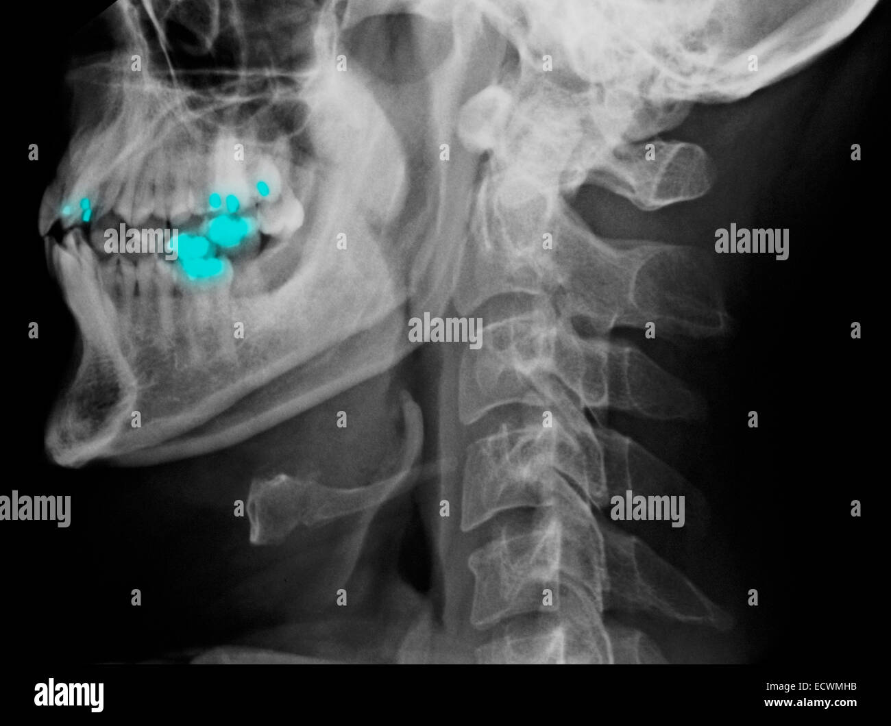X Rays Cervical Fotos e Imágenes de stock Alamy