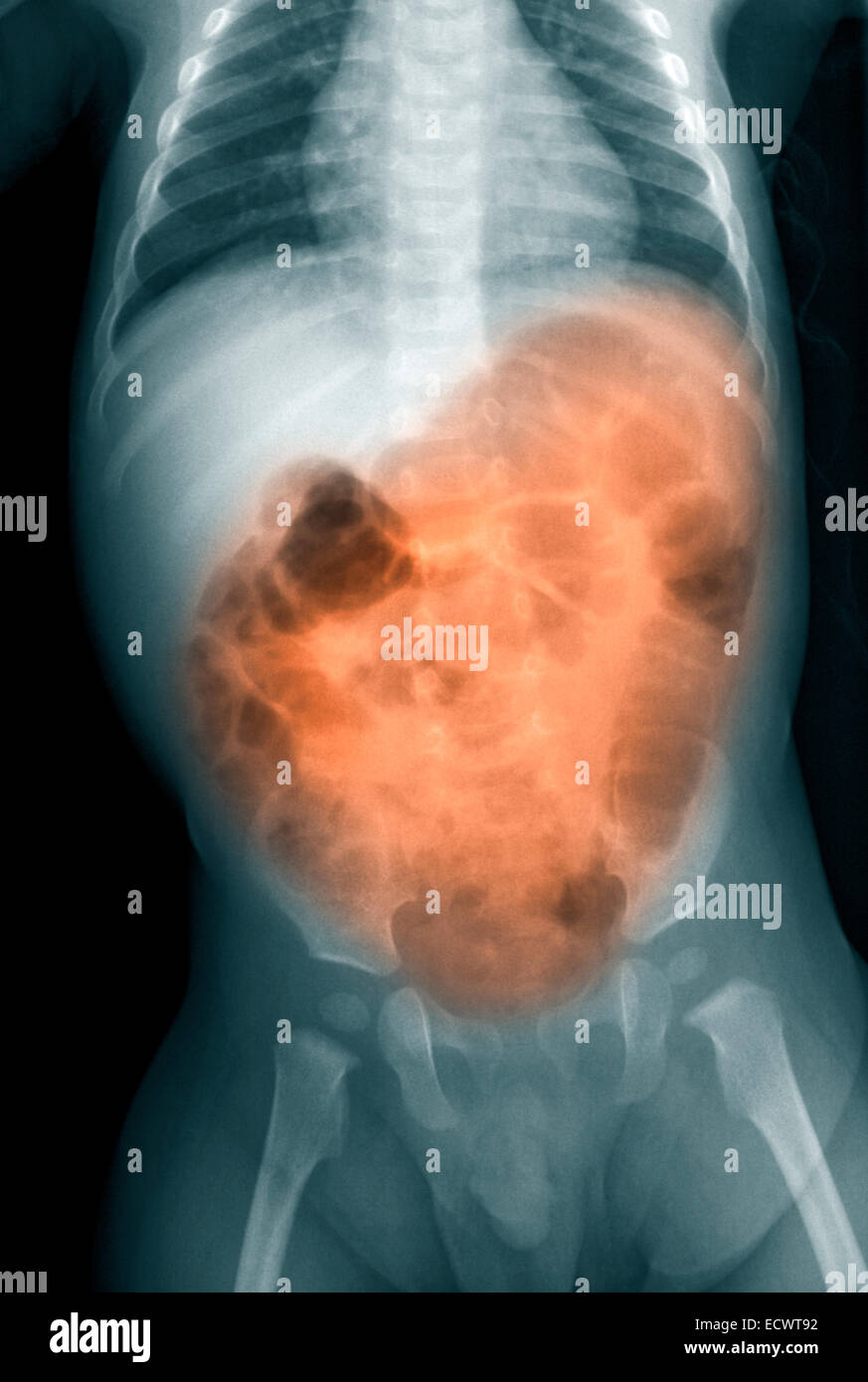 Rayos X de un niño de 7 meses con vómitos y diarrea. Foto de stock