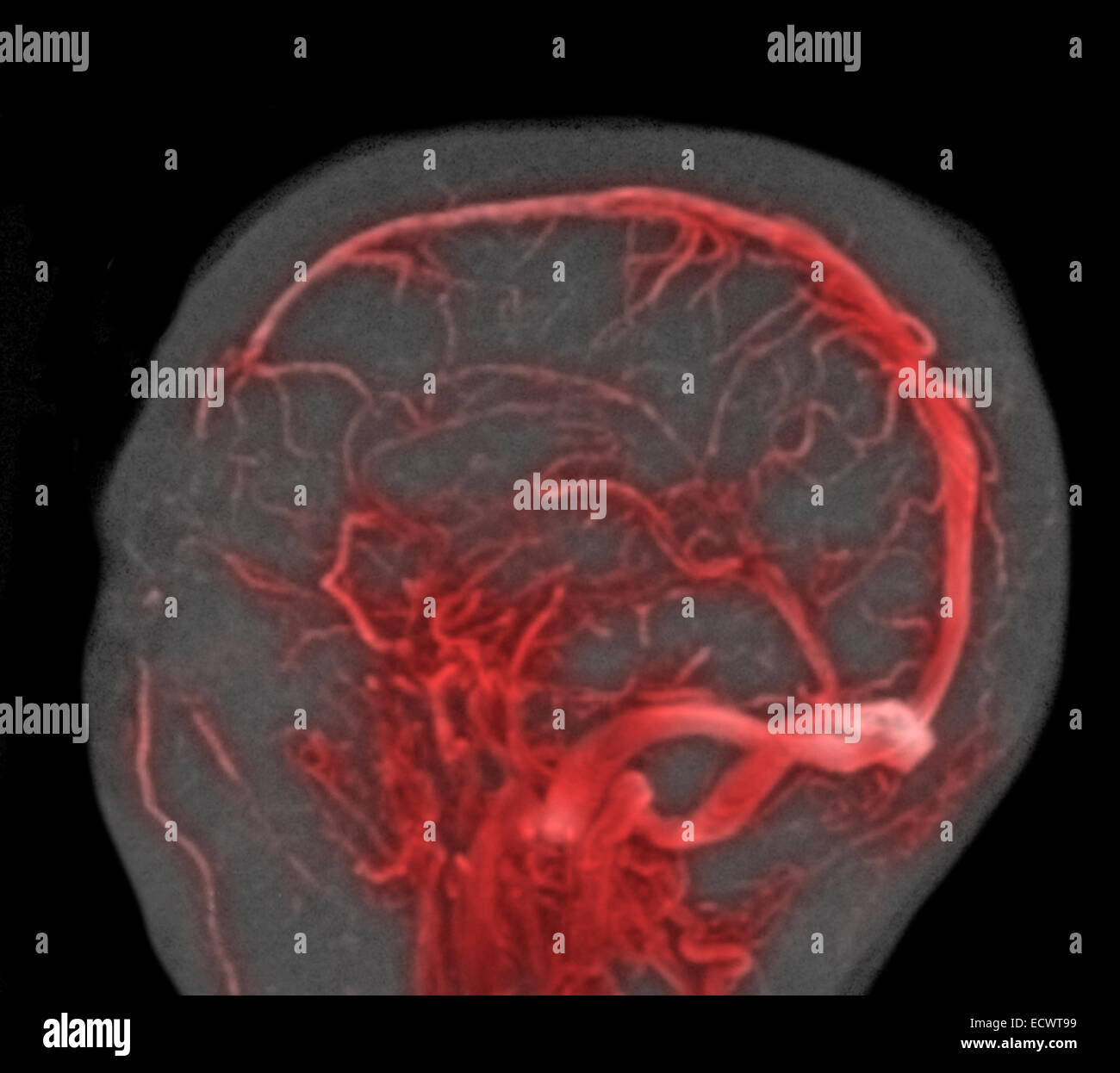 Estudio de MRI normal del cerebro. Foto de stock