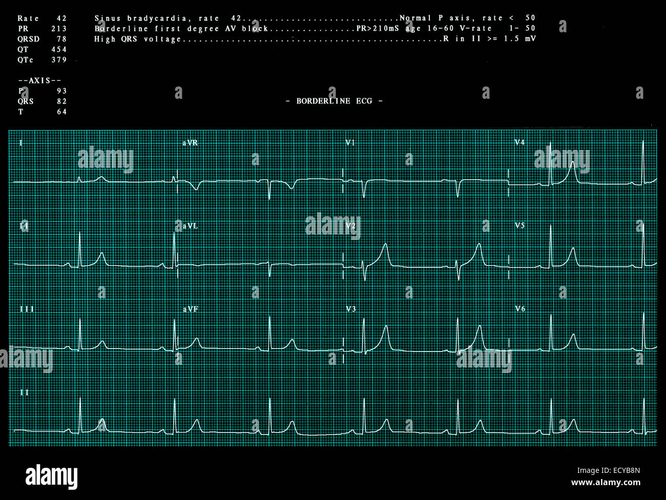 Electrocardiograma anormal mostrando una bradicardia sinusal Fotografía de stock Alamy