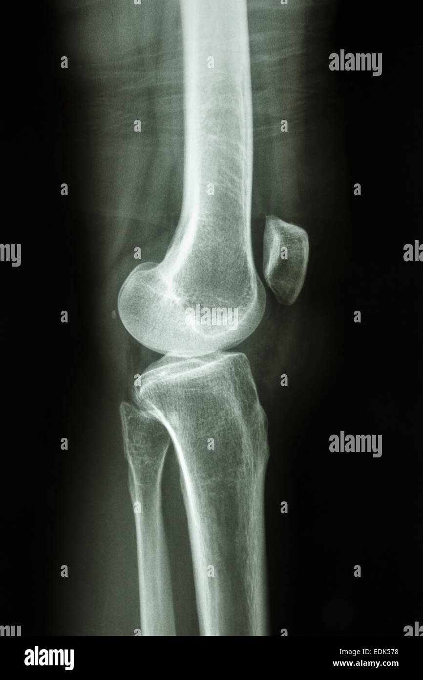 Flim radiografía lateral de rodilla : Mostrar la articulación de la rodilla del humano normal Foto de stock