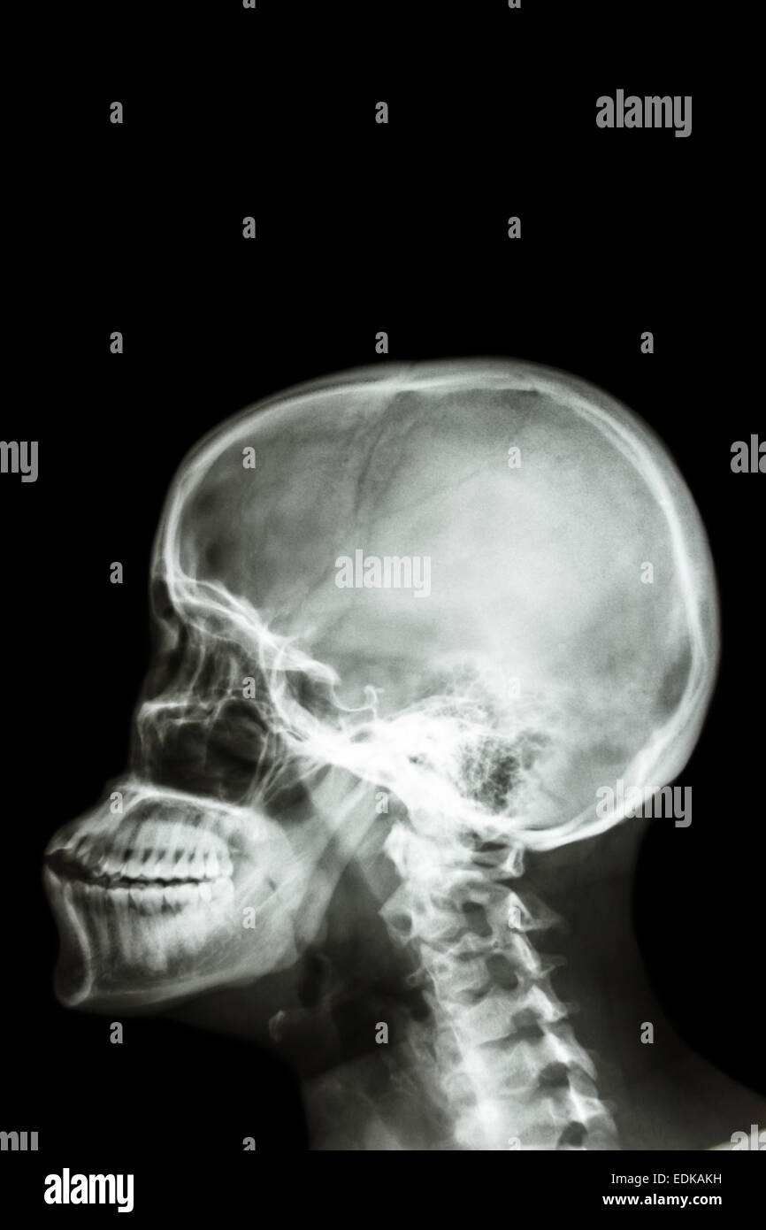 Película X-ray cráneo lateral : muestra el cráneo humano y el área en blanco en la parte superior para rellenar texto Foto de stock