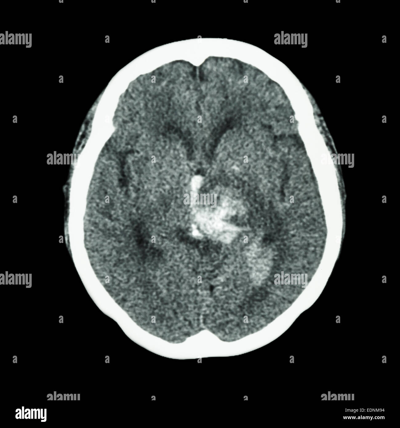 Una tomografía computarizada del cerebro : mostrar apoplejía hemorrágica Foto de stock