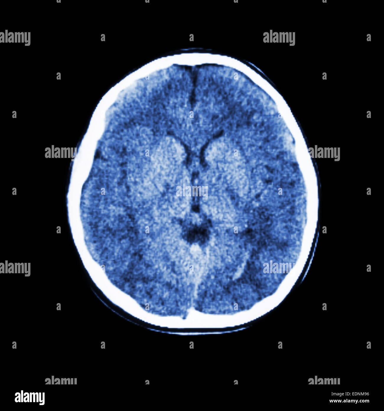 Tomografía computarizada normal del cerebro (Tomografía computarizada) Foto de stock