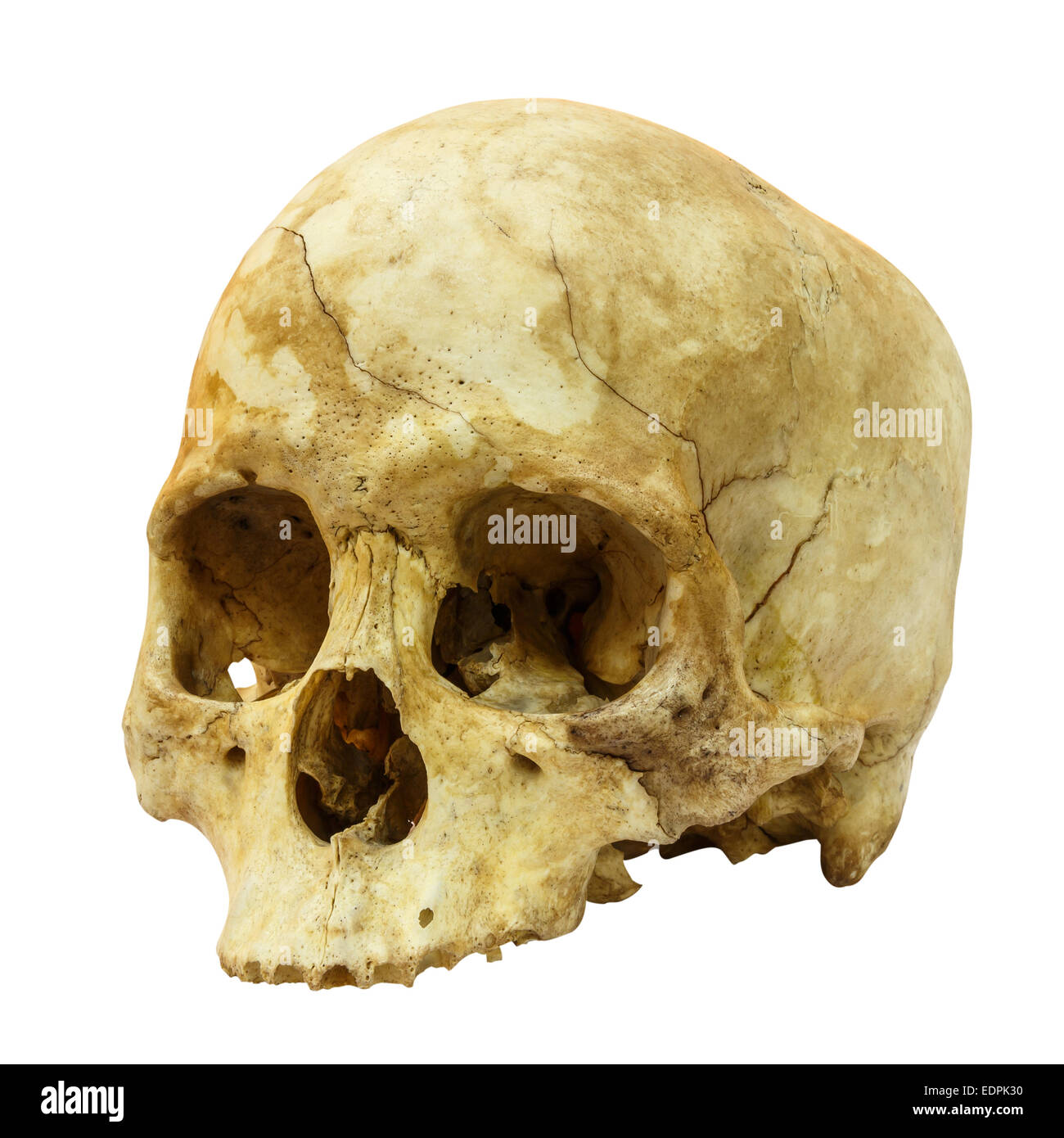 Fractura de cráneo humano(lado) (mongoloides,asiáticos) sobre fondo aislado Foto de stock