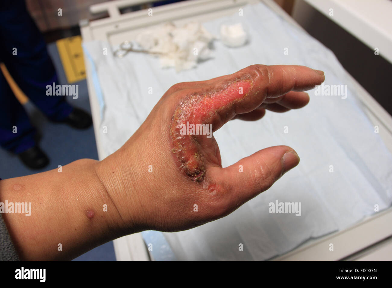 Izquierda masculino tiene un accidente, quemadura de segundo grado, la curación de la herida en la mano izquierda, Norfolk, UK Foto de stock