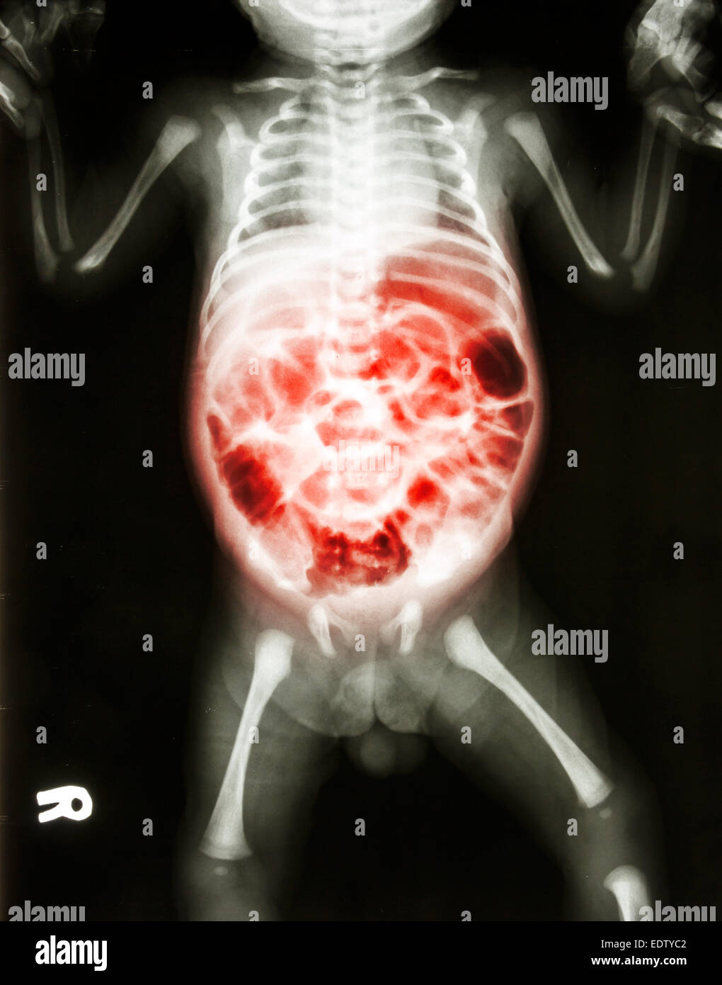 Enteritis (rayos X de lactantes enfermos e inflamación del intestino Fotografía de stock - Alamy