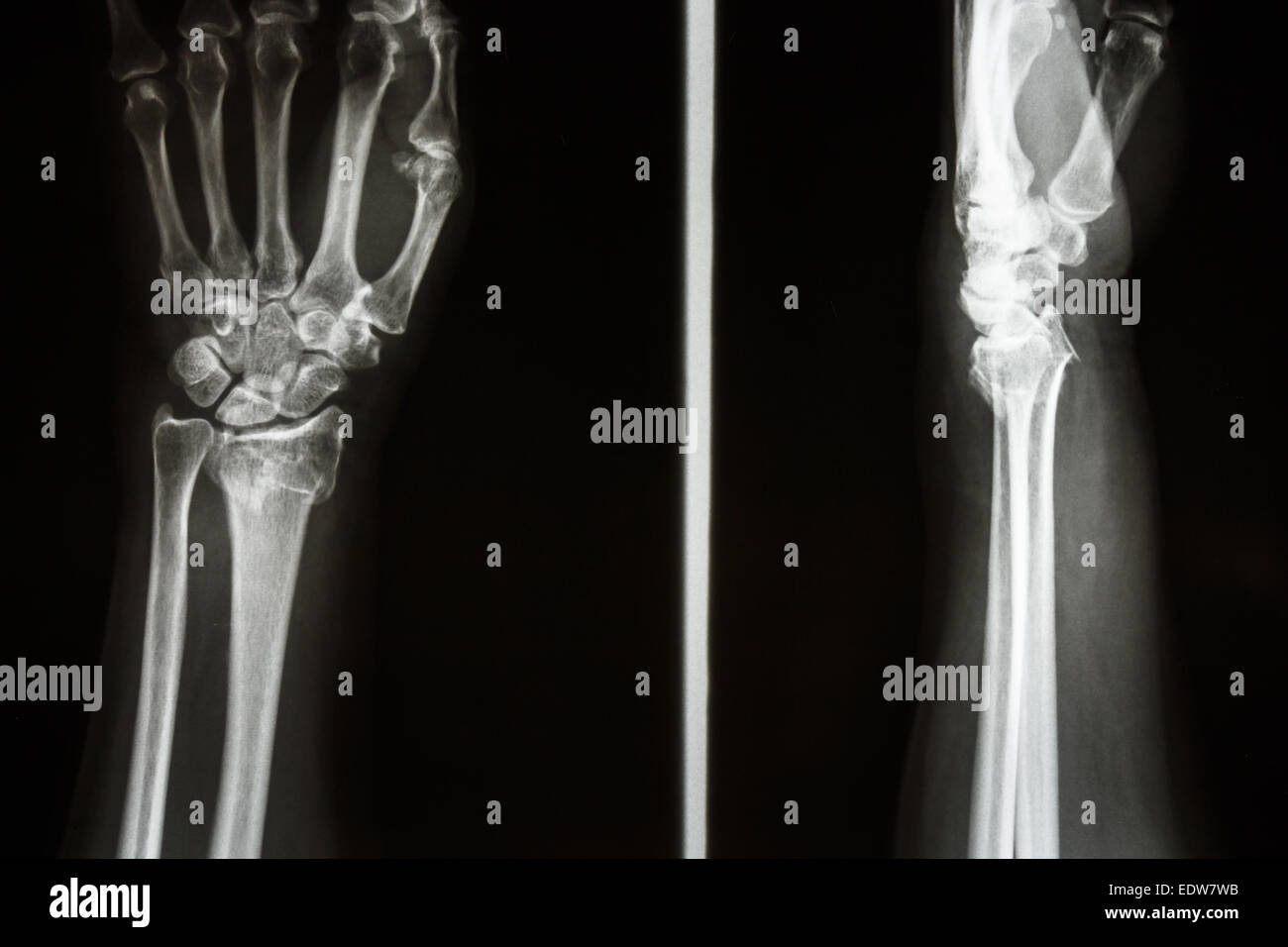 Película X-ray mostrar fractura distal del radio (fractura de Colles)  (muñeca Fotografía de stock - Alamy