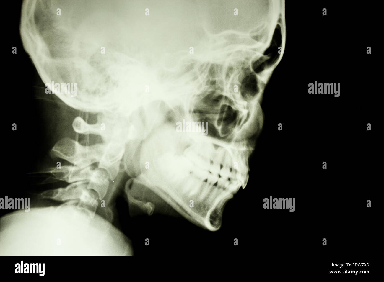 Película X-ray show normal del cráneo y de la columna cervical en los laterales (aislado) Foto de stock