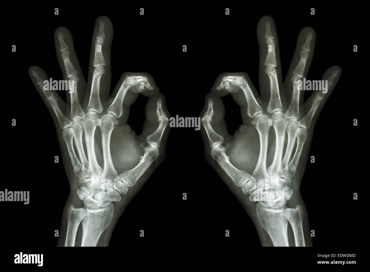 Manos con rayos X OK Registro Foto de stock