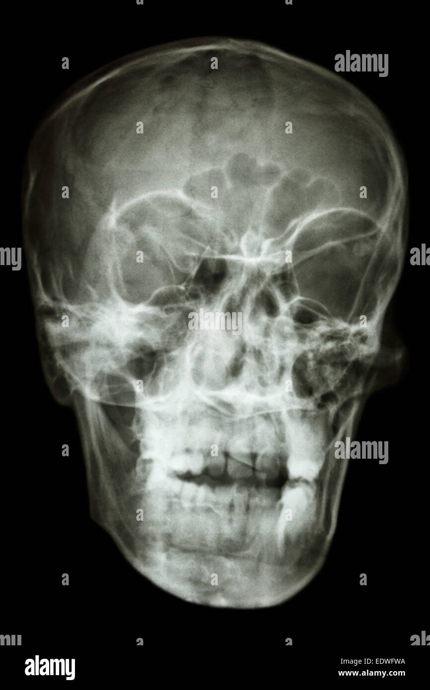 Película X-ray del pueblo asiático cráneo (pueblo tailandés) Foto de stock