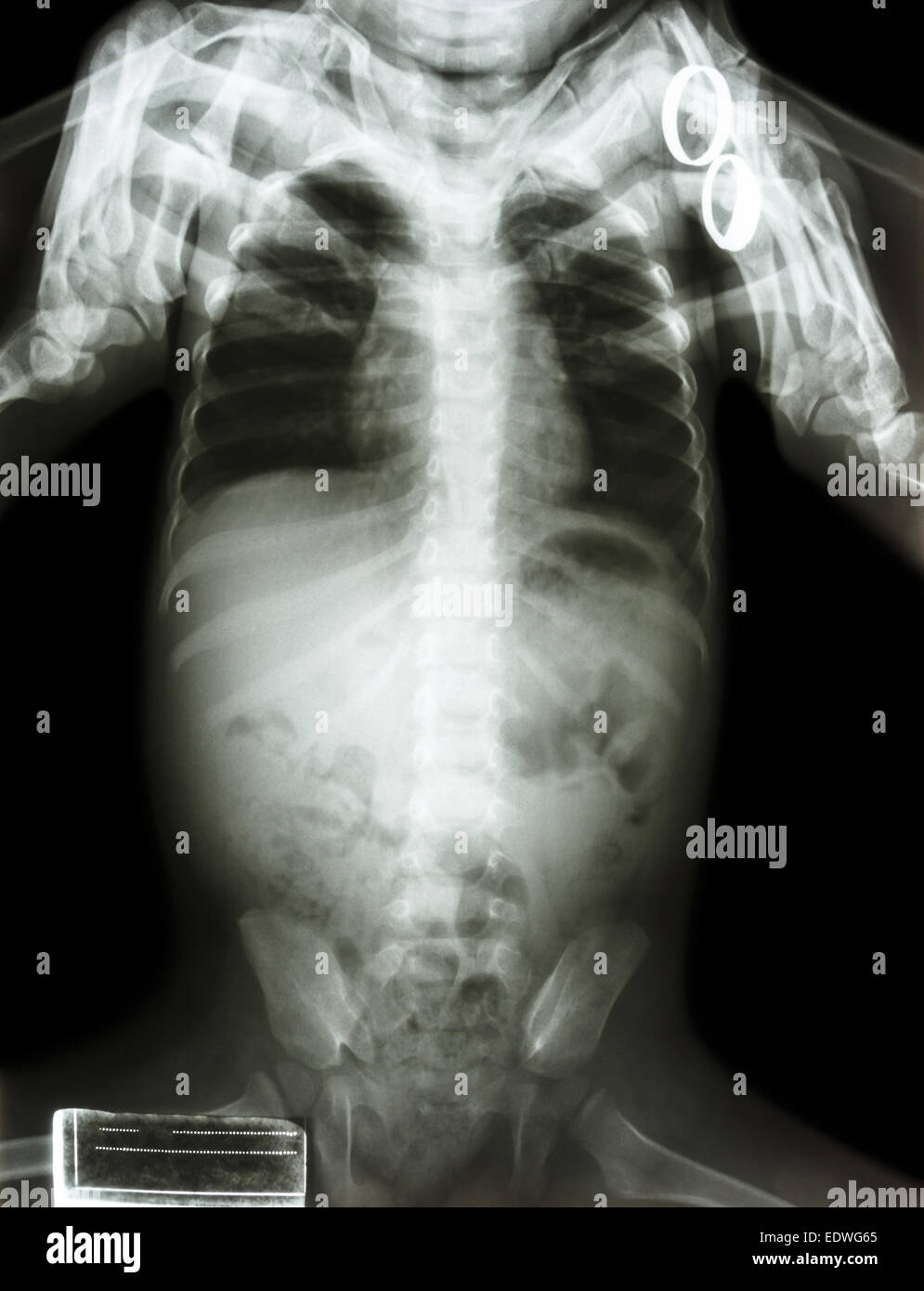 Película X-ray cuerpo de niño y adulto se mantiene en ambos hombros de bebé Foto de stock