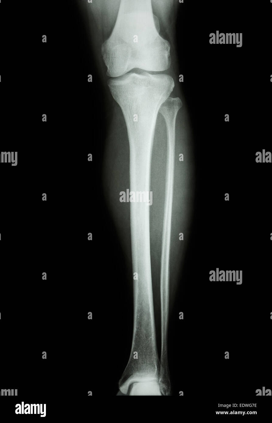 Película X-ray la pierna humana normal Foto de stock