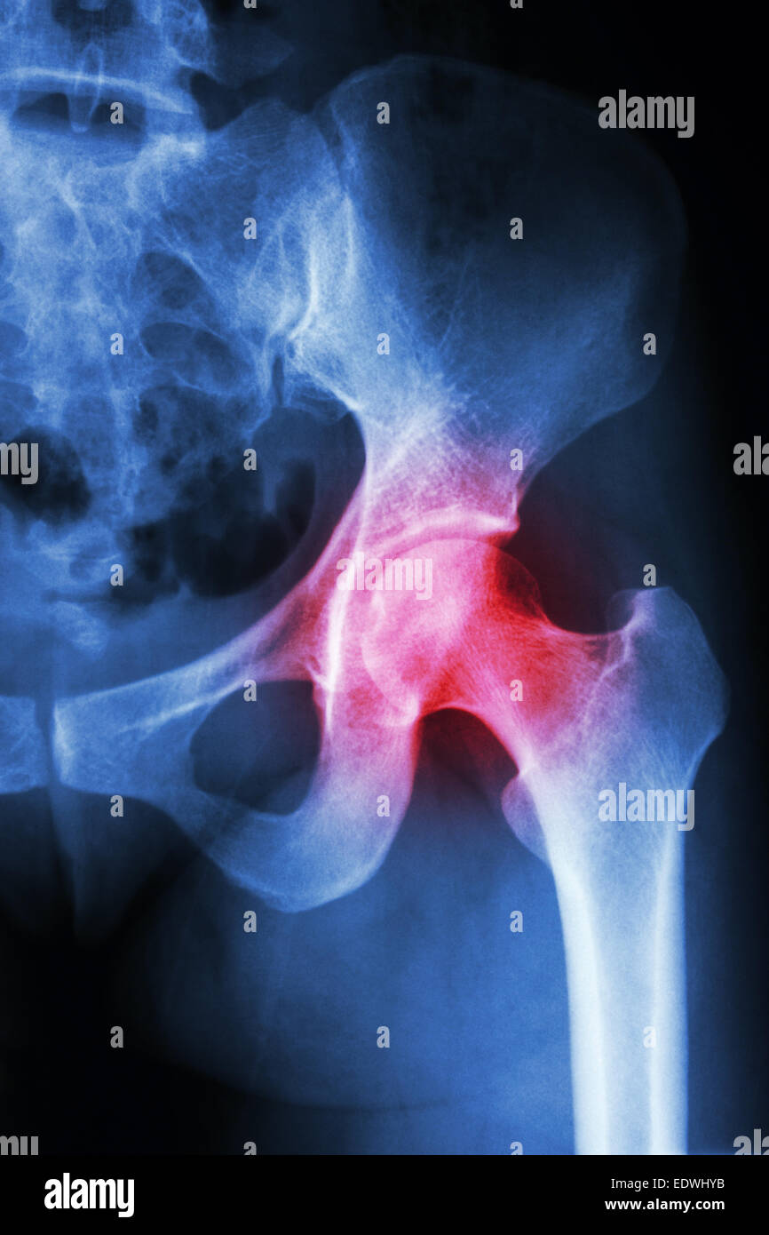 Artritis de cadera